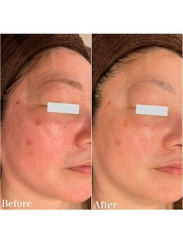 エノアビューティー(ENOA beauty)/たるみ小じわ改善/大人のハリ肌