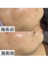 サロン ド エン(Salon de. en)/たるみケア◇ハーブピーリング