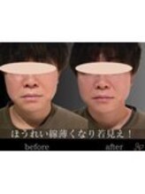 チョコバリ 錦糸町店(chocobari)/小顔×リフトアップ(美容鍼)20代