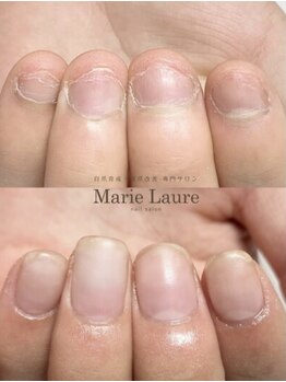 マリーロール 天王寺店(Marie Laure)/自爪育成/深爪矯正/ネイルケア