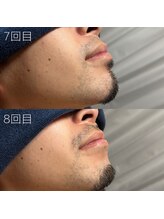カナウ(KANAU)/ヒゲ脱毛（20代前半男性）
