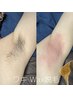 2週間ツルツルが持続◎黒ずみ対策やイベント前に! 両ワキ wax脱毛 ¥3,500