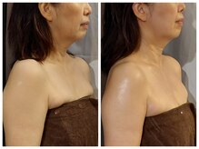 トコハナの雰囲気（【小顔&巻肩調整50代3回施術】肩が下がりフェイスラインすっきり）