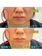 みつばちさろん/【ブラックスタンプ】エラ