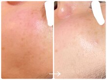 フォーチューン/ハーブトリートメント1回目♪