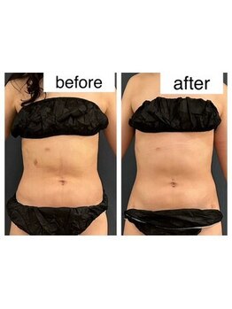 インディバサロン(INDIBA SALON 8296)/術前後のケアに！