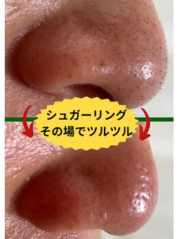 ディスイズミー シュガーリング(This is me Sugaring)/【シュガー】黒いポツポツ除去