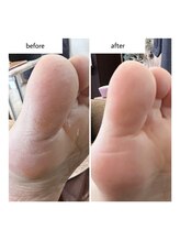 ネイルアトリエ ボン(nail atelier bon)/足裏角質ケア