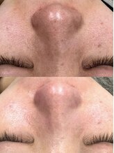 ホワイトアクア 明石店(WHITE AQUA)/毛穴洗浄1回目