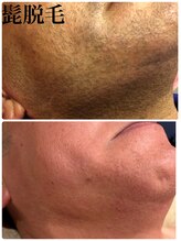 ひとつno武器/メンズヒゲ脱毛