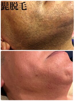 ひとつno武器/メンズヒゲ脱毛