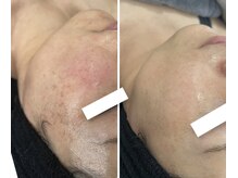 サロン ド ビューティージュエル(salon de beauty JEWEL)/プラズマニアor光フェイシャル