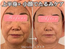 マリスステラ 天王寺(MarisStella)/小顔のお悩みに♪