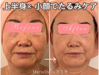 マリスステラ 天王寺(MarisStella)/小顔のお悩みに♪