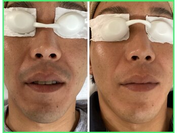 クリア 尾張旭店(Clear)/【Clear脱毛ビフォーアフター】