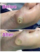 巻き爪補正店 八王子店/【タコ・魚の目ケア】