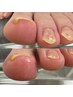 【トラブルケア】　巻き爪補正1か所　￥5500