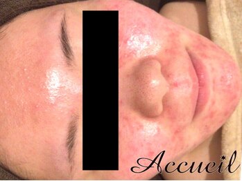 アクール(Accueil)/赤ら顔や敏感肌も◎