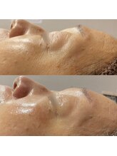 ダリア(DAHLIA)/シワ改善2/REVIハーブピーリング