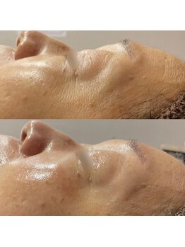 ダリア(DAHLIA)/シワ改善2/REVIハーブピーリング