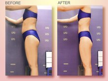 ジュリア オージェ 四条河原町店/ ビフォーアフター（脂肪燃焼)