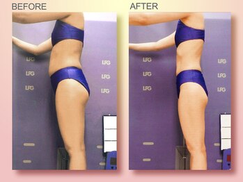 ジュリア オージェ 四条河原町店/ ビフォーアフター（脂肪燃焼)