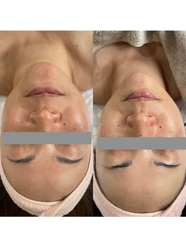 アンド(and...)/フェイシャルトリートメント