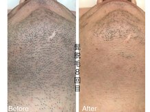 CDF 赤坂/メンズヒゲ脱毛８回目初回￥1000