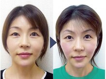 美デザイン 表参道店(美.design)/☆小顔矯正+首肩矯正