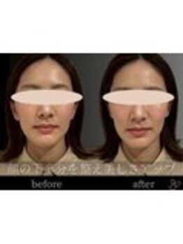 チョコバリ 錦糸町店(chocobari)/小顔×リフトアップ(美容鍼)20代