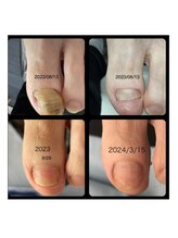 ナチュエイド/肥厚・変形爪自爪育成ケア