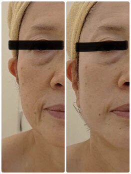 エルミナ.(elmina.)/頬ほうれい線改善　脂肪増殖5ml