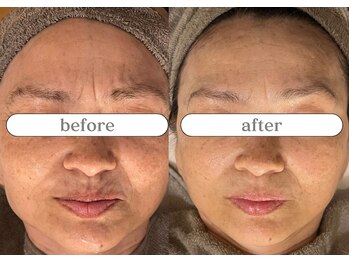 リスタ(RSTA)/【BEFORE/AFTER】