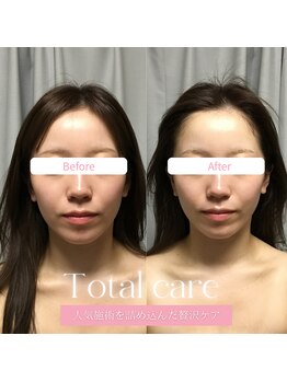 ブリリオプラス 四条烏丸店(Brillio plus)/ブライトニング★フォトIPL