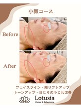 ルトゥーシア(Lotusia)/小顔　　before→after