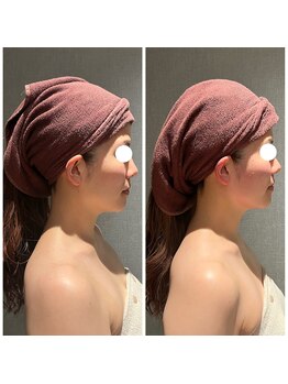 ギンザクリア 銀座本店(GINZA CLEAR)/リフトアップ超音波＋小顔コルギ