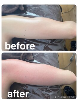 ギンザアール(GINZA R.)/二の腕にアプローチ！