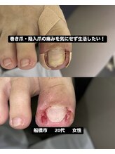 巻き爪じゅん 船橋店/陥入爪の痛み気にせず生活したい