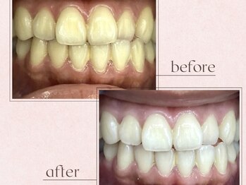 ルアナシンフォニア エクシア 恵比寿店(Luana-Sinfonia)/ホワイトニングビフォーアフター