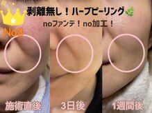 シェリー(Cheri)/【ハーブピーリング剥離無】お顔