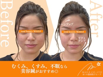 まいれ整骨院 東近江院/美容鍼（20代女性/施術1回目）