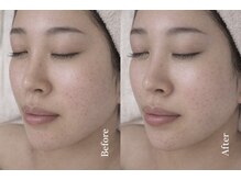 サロンド テン 広尾(salon de TEN)/広尾ハーブピーリング