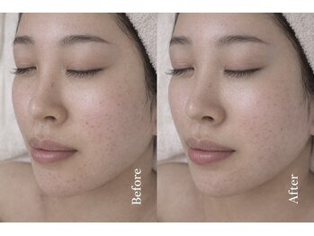 サロンド テン 広尾(salon de TEN)/広尾ハーブピーリング