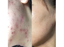 シャイネル(SHYNELL)の雰囲気（大人気ハーブリプロで叶える肌質改善☆誰もがなりたい素肌へ）