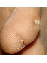 角質フットケアサロン リラックスパーク 大阪難波店(RelaxPark)/足小指の魚の目/足裏の角質除去