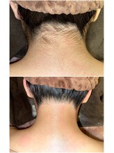 エースタイル(A-style.)/うなじ☆シュガーリング脱毛