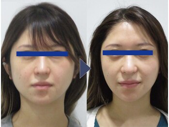 美デザイン 表参道店(美.design)/☆小顔矯正+頭蓋骨矯正+首肩矯正