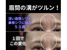 目元 口元のたるみ 眉間シワ改善専門サロン/眉間のシワに悩んでいる方用
