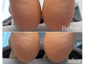 カシェット 広島店(Cachette)/30代女性☆足裏角質ケア60分