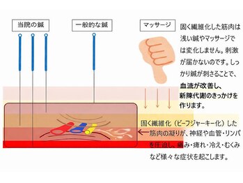 北京堂鍼灸首里 いじゅ治療院/固く繊維化したインナーマッスル